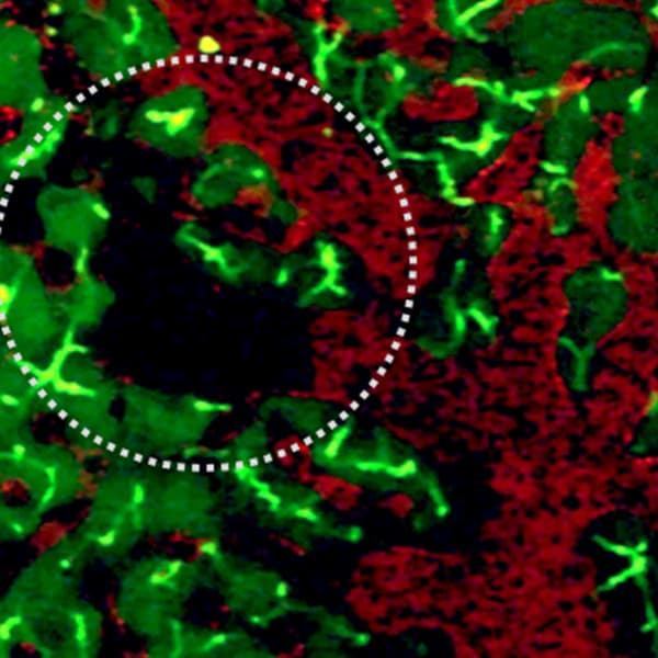 Intravital imaging of sickle cell mouse liver. In red Texas red dextran and Carboxyflurescein is in green. Circled area shows vasoocclusion.