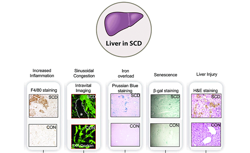 Liver in SCD Illustration