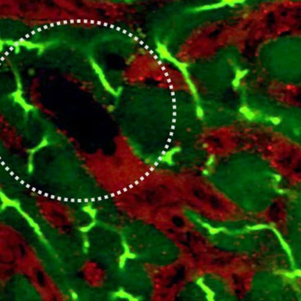 Intravital imaging of sickle cell mouse liver . In red Texas red dextran and Carboxyflurescein is in green. Circled area shows vasoocclusion.